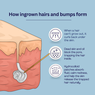 NEW: Clear-Out Patches (with Salicylic Acid)